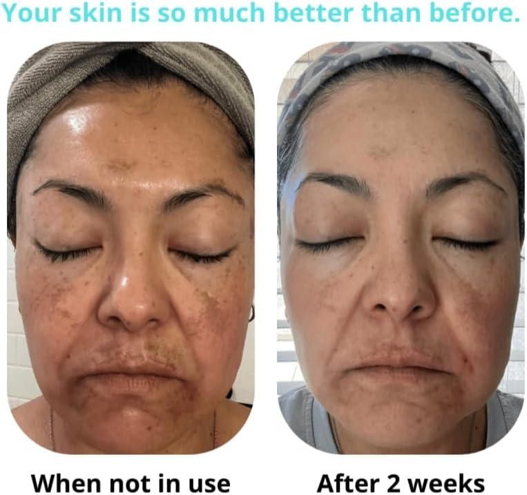 Saam Renewal Face Cream, Remove Wrinkles, Melasma, Freckles, Skin Aging, Dark skin - Buy 1 Get 1 Free